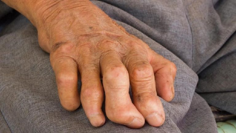 Kemenkes Respons WNI Jadi Kasus Pertama Kusta di Rumania Usai 44 Tahun