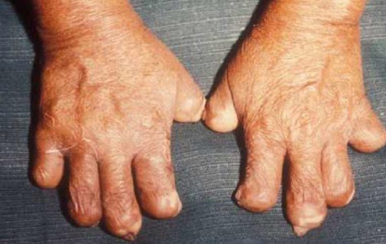 Viral! 2 WNI Terkonfirmasi Mengidap Penyakit Kusta di Rumania, Kasus Pertama Setelah 40 Tahun : Okezone Women