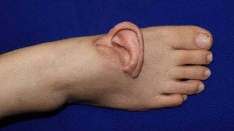 Telinga Wanita Ini di Ada Kaki Pascaoperasi Kecelakaan Kerja : Okezone Women